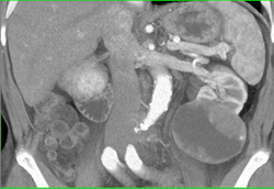 Cystic Renal Cell Carcinoma - CTisus CT Scan