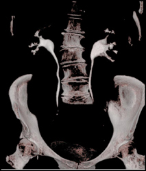 Transitional Cell Carcinoma-left Kidney-lower Pole Calyx - CTisus CT Scan