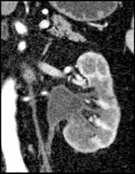 Transitional Cell Carcinoma - CTisus CT Scan