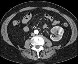 Transitional Cell Carcinoma - CTisus CT Scan