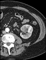 Transitional Cell Carcinoma - CTisus CT Scan