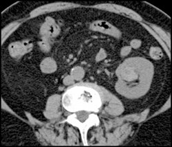 High Density Renal Cyst - CTisus CT Scan