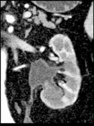 Transitional Cell Carcinoma - CTisus CT Scan