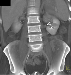 Renal Cell Carcinoma - CTisus CT Scan