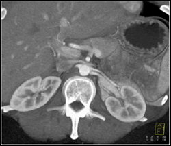 2 Left Renal Arteries - CTisus CT Scan