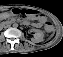 High Density Renal Cyst - CTisus CT Scan