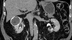 Complex Cysts in Both Kidneys - CTisus CT Scan