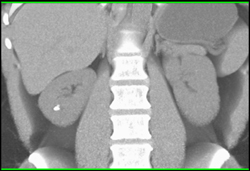 Diverticulum of Calyx With Stone - CTisus CT Scan