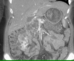 Renal Cysts and Left Renal Carcinoma in Patient With Von Hippel Lindau Syndrome - CTisus CT Scan