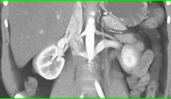 Retroaortic Renal Vein - CTisus CT Scan