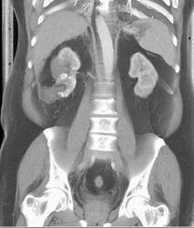 Post Radiofrequency Ablation (RFA) Right Kidney - CTisus CT Scan