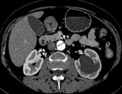 Decreased Left Renal Function With Aortic Dissection - CTisus CT Scan