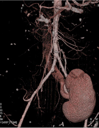 CTA With Transplant Kidney Seen With Editing Software - CTisus CT Scan