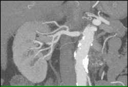 Renal Artery Stenosis - CTisus CT Scan