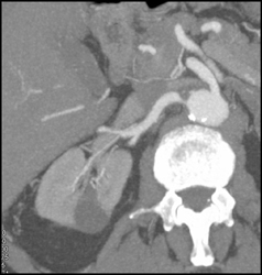 Renal Artery Stenosis - CTisus CT Scan