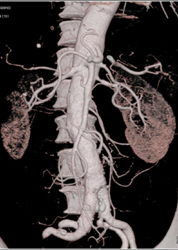 Asymmetric Renal Function - CTisus CT Scan