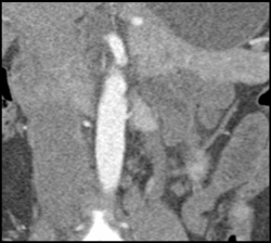 2nd Renal Artery Only Seen With 3D in Potential Renal Donor - CTisus CT Scan