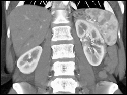 1 Cm Renal Cell Carcinoma of the Left Kidney - CTisus CT Scan