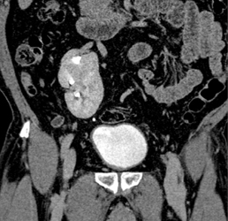 Pelvic Kidney - CTisus CT Scan