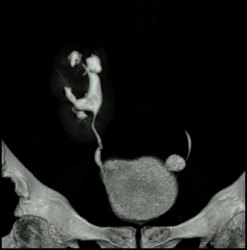 Pelvic Kidney - CTisus CT Scan