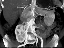 Pelvic Kidney - CTisus CT Scan