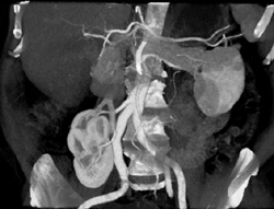 Pelvic Kidney - CTisus CT Scan