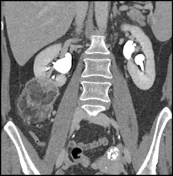 Angiomyelolipoma That Previously Bled - CTisus CT Scan