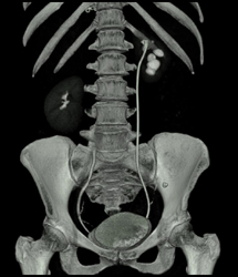 Atrophic Left Kidney With Hydronephrosis Due to Metastatic Breast Cancer to Ureter - CTisus CT Scan