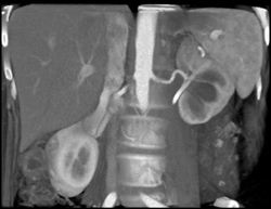 Renal Artery Encased With Breast Cancer - CTisus CT Scan