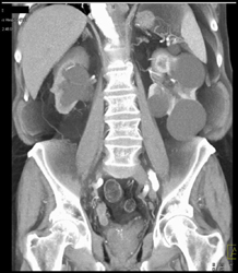 Renal Cysts and Right Hydronephrosis With Tumor in Distal Right Ureter - CTisus CT Scan