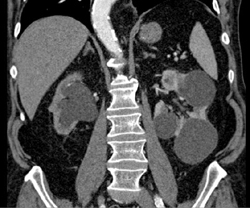 Tumor in Distal Right Ureter - CTisus CT Scan