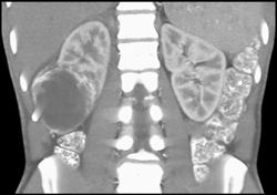 Renal Abscess - CTisus CT Scan