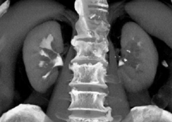 Transitional Cell Carcinoma of the Right Kidney - CTisus CT Scan