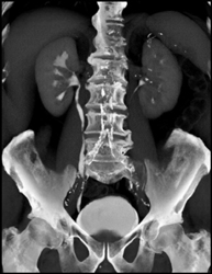 Transitional Cell Carcinoma-lower Pole of Right Kidney - CTisus CT Scan