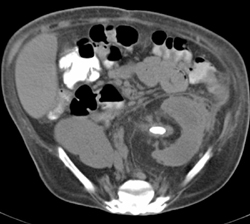 Stone in Renal Pelvis With Perinephric Stranding - CTisus CT Scan