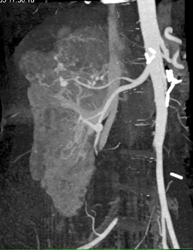 Multiple Angiomyolipomas With Small Aneurysms in Large Right Kidney - CTisus CT Scan