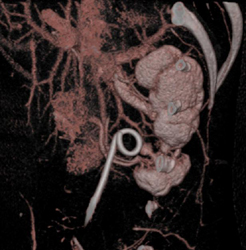 Ureteropelvic Junction (UPJ) Due to Crossing Lower Pole Renal Arteries - CTisus CT Scan