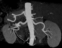 Right Renal Artery Aneurysm - CTisus CT Scan