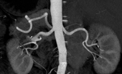 Right Renal Artery Aneurysm - CTisus CT Scan