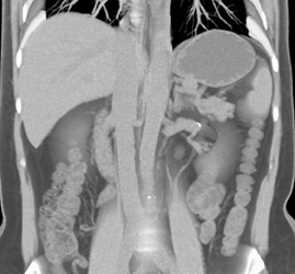 Right Renal Artery Aneurysm - CTisus CT Scan