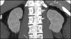 1 Cm Renal Cell Carcinoma - CTisus CT Scan