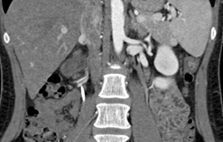 Ureteropelvic Junction (UPJ) on Left - CTisus CT Scan