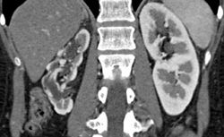 Scarring of Right Kidney - CTisus CT Scan