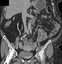 Subtle Transitional Cell Carcinoma of the Right Ureter-has Subtle Calcification - CTisus CT Scan