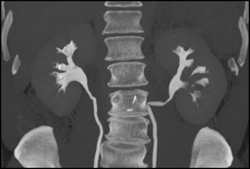 Transitional Cell Carcinoma of the Left Kidney - CTisus CT Scan