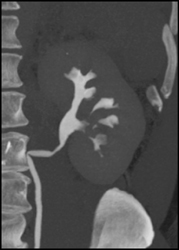 Transitional Cell Carcinoma of the Left Kidney - CTisus CT Scan