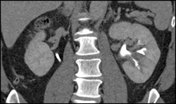 Transitional Cell Carcinoma of the Left Kidney - CTisus CT Scan