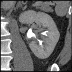 Transitional Cell Carcinoma of the Left Kidney - CTisus CT Scan