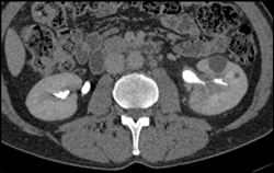 Transitional Cell Carcinoma of the Left Kidney - CTisus CT Scan