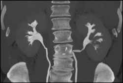 Transitional Cell Carcinoma of the Left Kidney - CTisus CT Scan